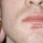Длинный список пирсинг пупка проблемы Как удалить шрам от прокола носа